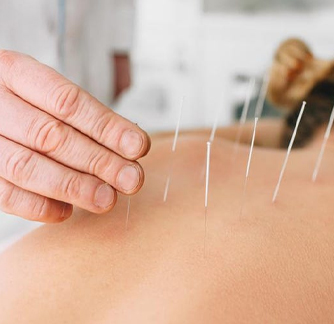  Acupuncture 